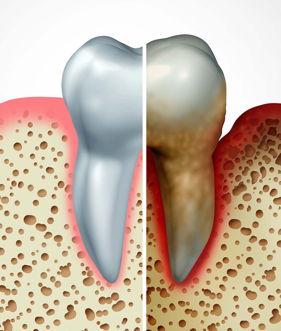 DIagram of a tooth divided in half illustrating a healthy tooth and unhealthy tooth